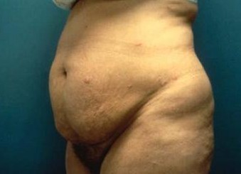 李发成  产后肚皮松44.jpg