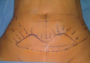 李发成  产后肚皮松55.jpg