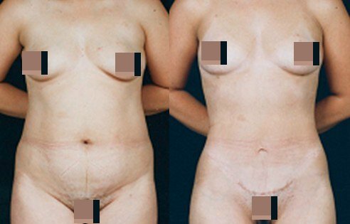 李发成  产后肚皮松66.jpg