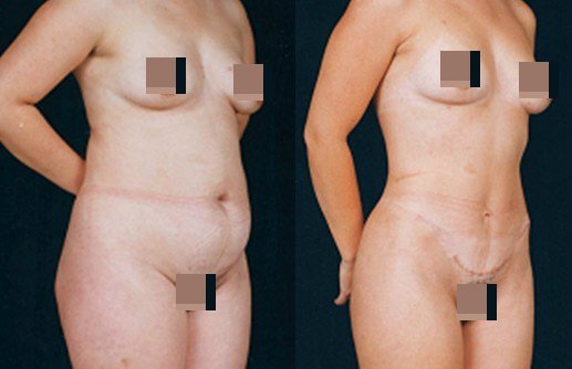 李发成  产后肚皮松77.jpg