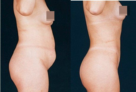 李发成  产后肚皮松88.jpg