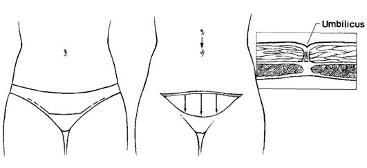 李发成  产后肚皮松99.jpg