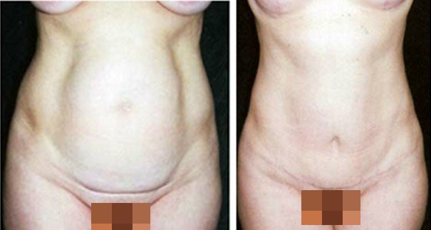 李发成  产后肚皮松11.jpg