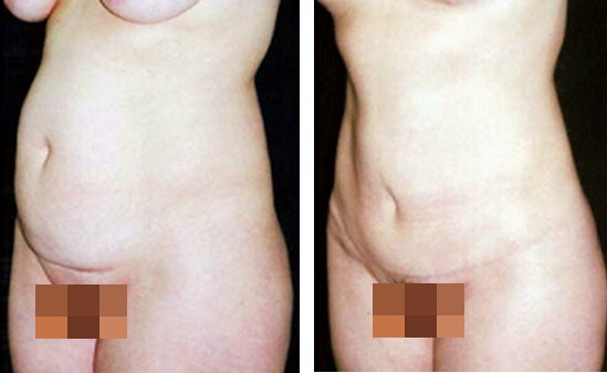 李发成  产后肚皮松12.jpg