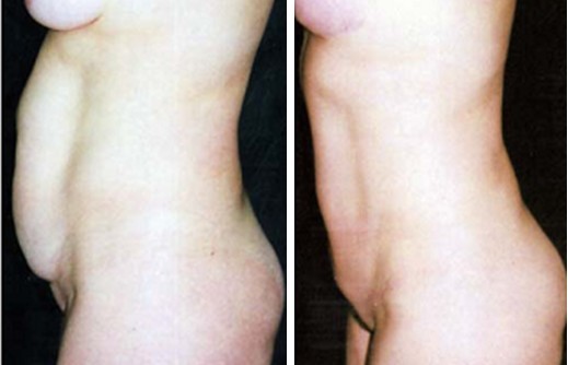 李发成  产后肚皮松13.jpg