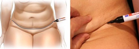 李发成  产后肚皮松14.jpg