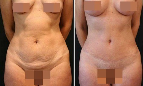 李发成  产后肚皮松15.jpg