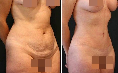 李发成  产后肚皮松16.jpg