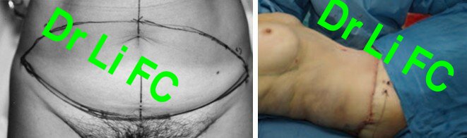 李发成  产后肚皮松17.jpg