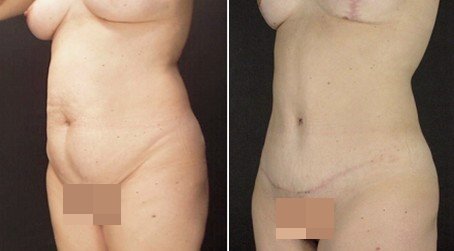 李发成  产后肚皮松18.jpg