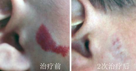 综合方案治疗婴幼儿血管瘤 图片.jpg