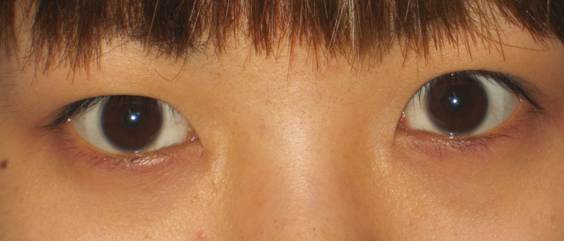 陈文 内眼角开大的新方法 图片1.jpg
