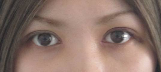 陈文 内眼角开大的新方法 图片2.jpg